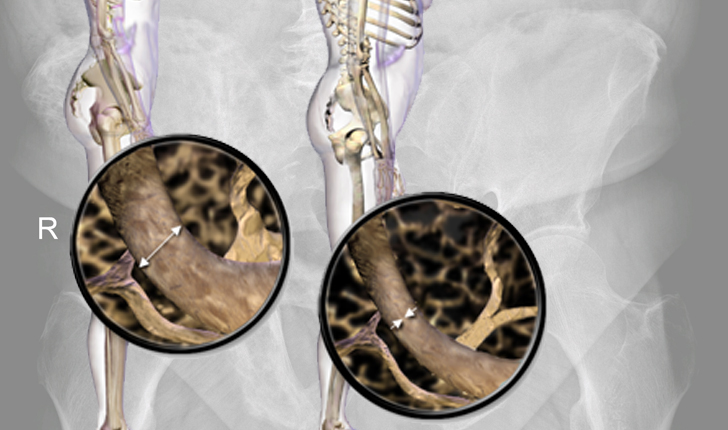La osteoporosis es la enfermedad más frecuente del tejido óseo.