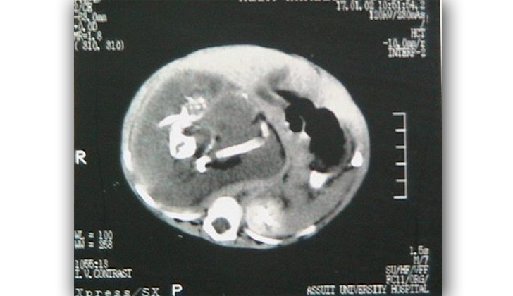 El fetus in fetu, gemelo parásito o mellizo parásito, es una formación humanoide creada por un accidente en cierto punto de la formación del cigoto antes de la formación del embrión.