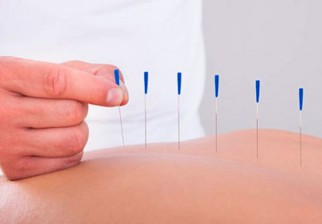 La acupuntura sería igual de eficaz que los fármacos para tratar el estrés. Foto: EFE