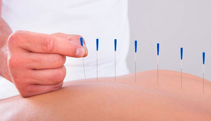 La acupuntura sería igual de eficaz que los fármacos para tratar el estrés. Foto: EFE