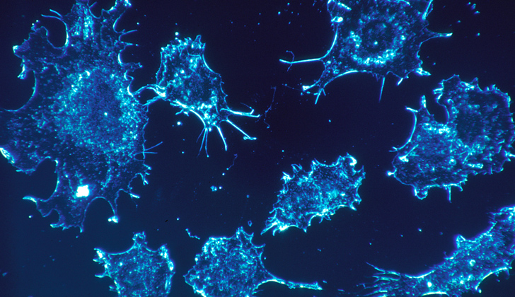 Imagen de microscopio de células cancerígenas. Foto: Wikimedia Commons. 