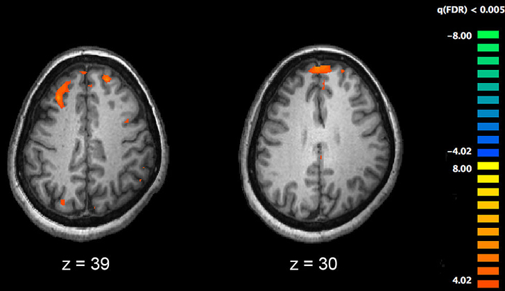 Imagen por resonancia magnética funcional (fMRI) mostrando dos niveles del cerebro. Las áreas en color naranja fuero más activas en personas en condiciones saludables, que las personas que estaban medicadas por esquizofrenia. Foto: Wikimedia Commons.