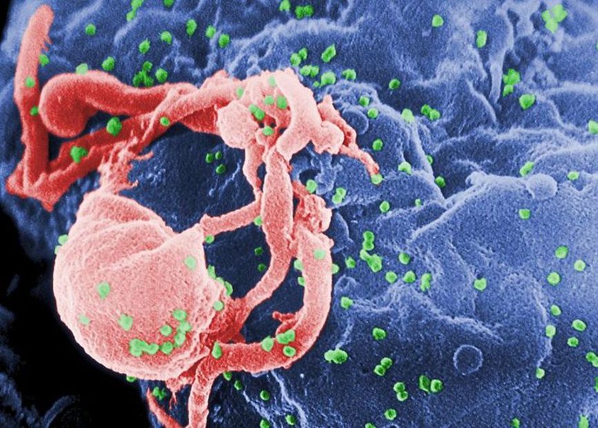 Linfocito atacado por VIH. FOto: Wikimedia Commons 