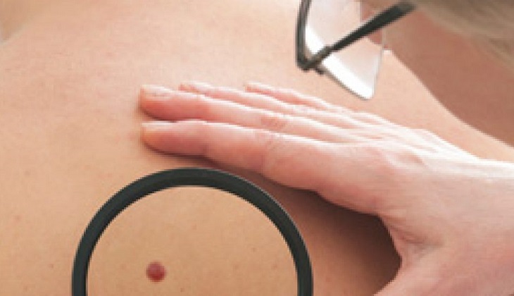 Día mundial contra el melanoma, el cáncer más agresivo de la piel