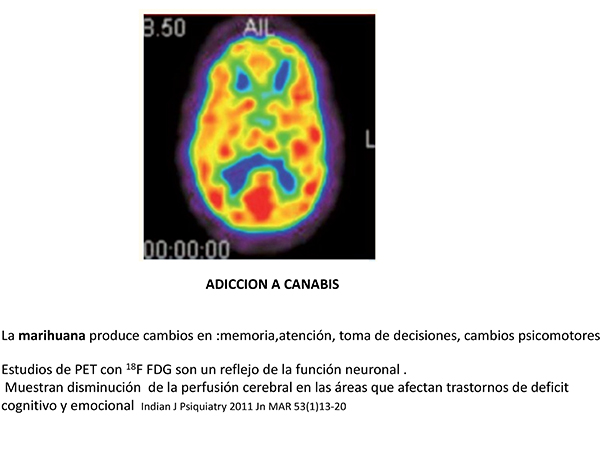 Imágenes del cerebro humano realizadas por tomografía de emisión de positrones (PET). Fuente: Presidencia de la República. 
