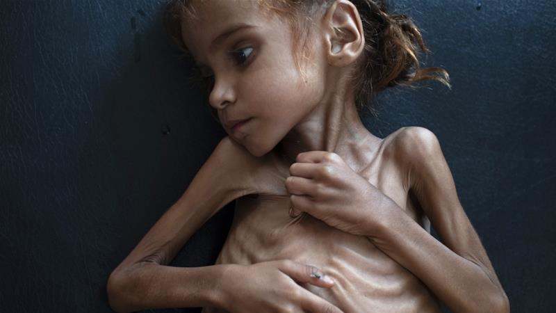 Amal Hussain murió de desnutrición este jueves. Foto: Tyler Hicks / The New York Times / Redux