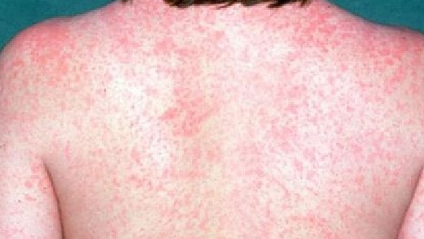 Uno de los síntomas del sarampión son grandes erupciones de la piel