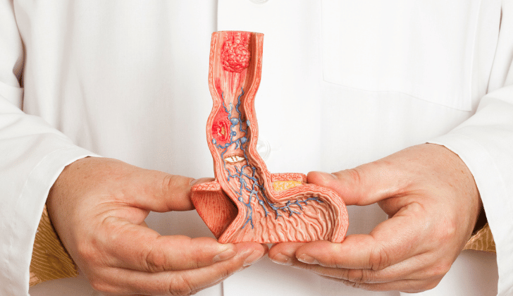 Modelo anatómico de una sección frontal de la parte inferior del esófago desde epitelio escamoso normal hasta epitelio columnar esofágico. El modelo muestra las siguientes enfermedades: esofagitis por reflujo, úlcera y esófago de Barrett.