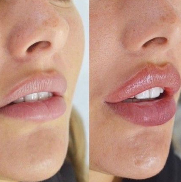 botox