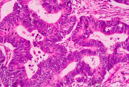 Adenocarcinoma-