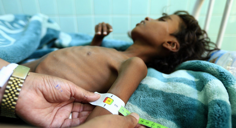 Un doctor mide el brazo de Ali Mohammed Ahmed Jamal, un niño de 12 años que ingresó por malnutrición en el hospital de Saná. Foto: UNICEF / Huwais