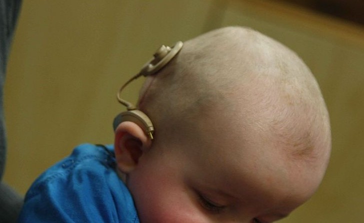 Un bebé con un implante coclear. Foto: Wikimedia Commons