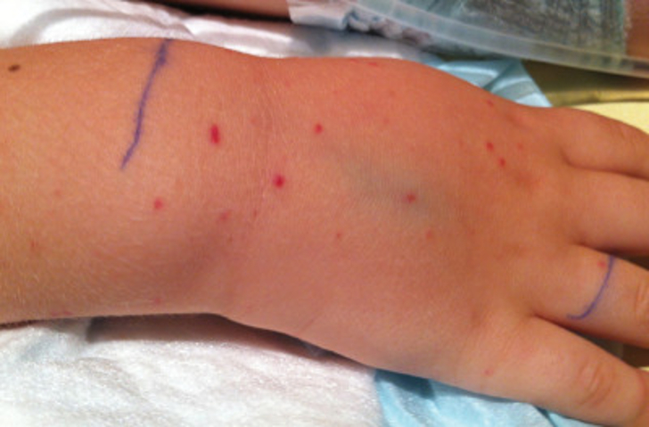 Caso leve de púrpura fulminante, que puede derivar en manifestaciones cutáneas severas.